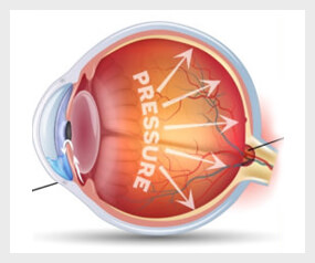 Healthy eye
